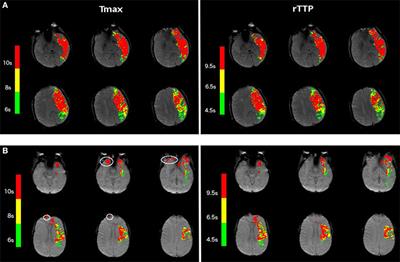 A Comparison of Relative Time to Peak and Tmax for Mismatch-Based Patient Selection